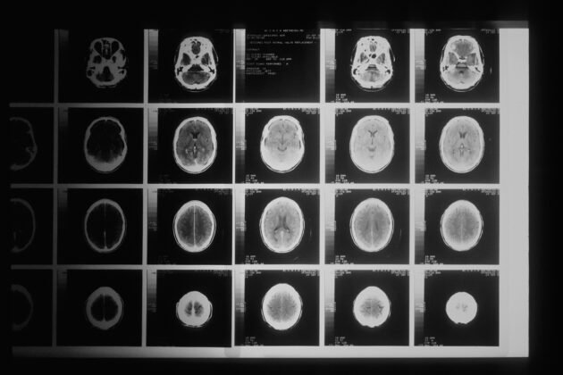 AI vs. MDS: A ferramenta Microsoft AI supera os médicos no diagnóstico de casos médicos complexos